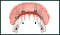 Denture Success - Internet Find 2