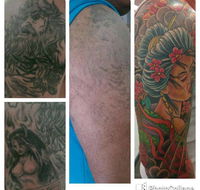 Laserpro Tattoo Removal - Internet Find