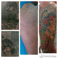 Laserpro Tattoo Removal